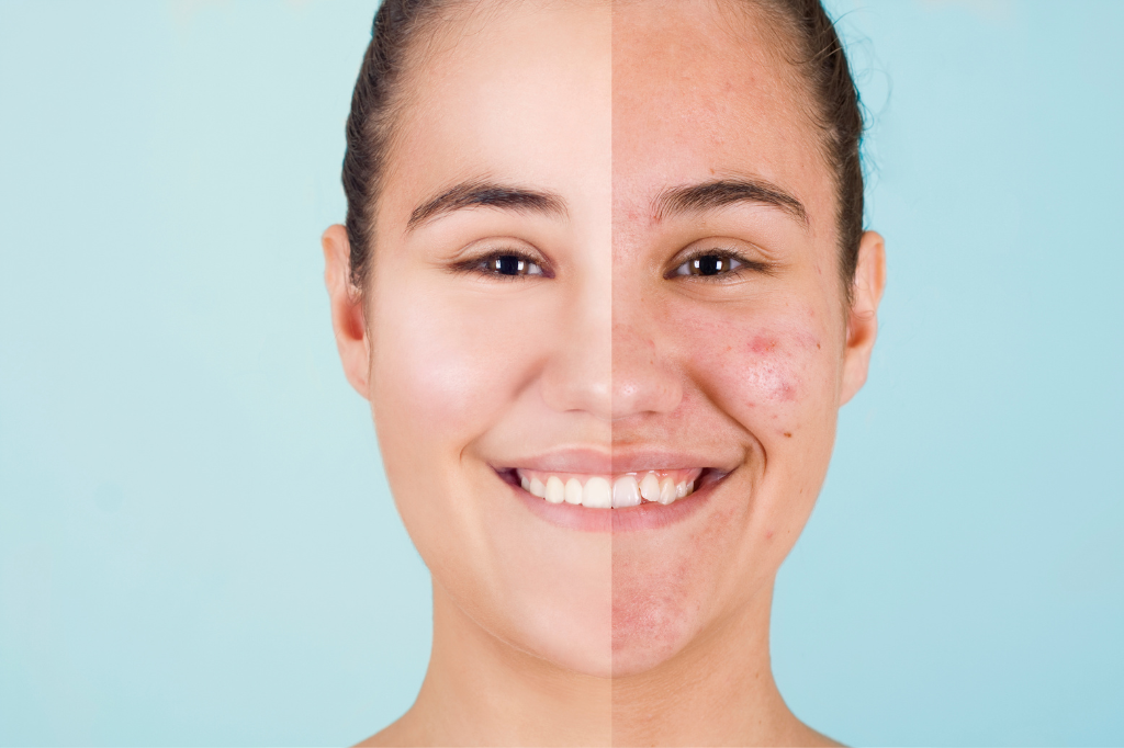Se hai problemi con l'acne è importante leggere questo articolo